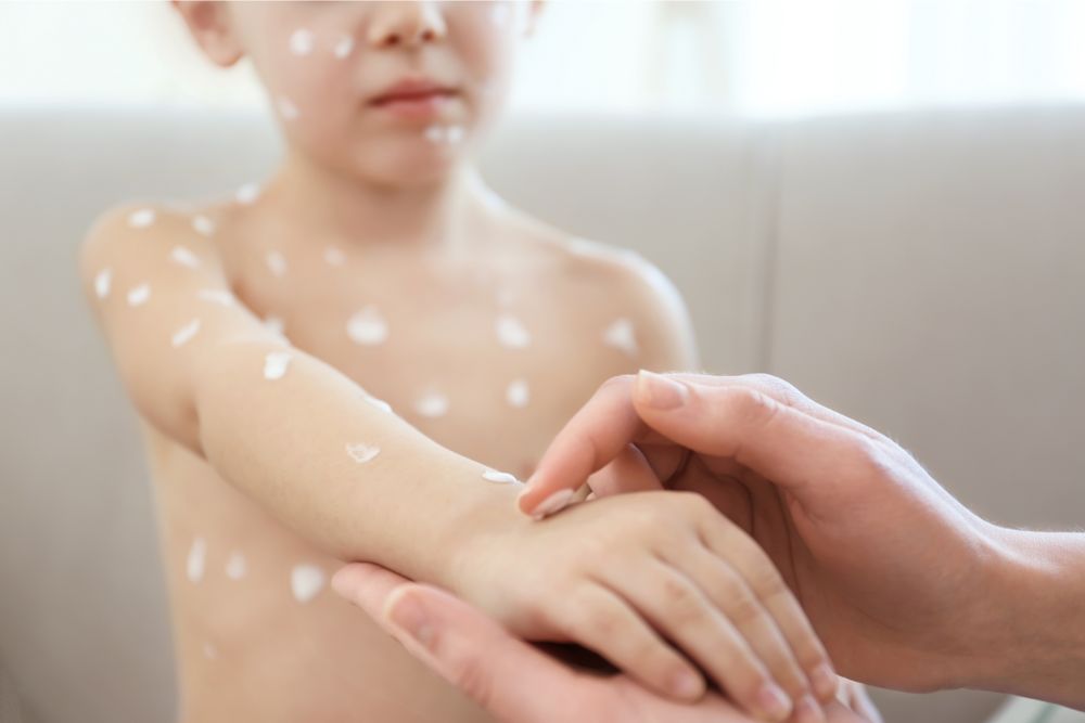Female Hands Applying Cream onto Skin of Child Ill with Chickenpox